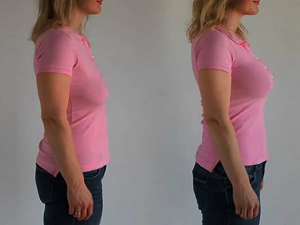 Complications of female breast surgery