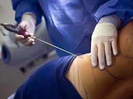 Symptoms-of-embolism-after-abdominoplasty