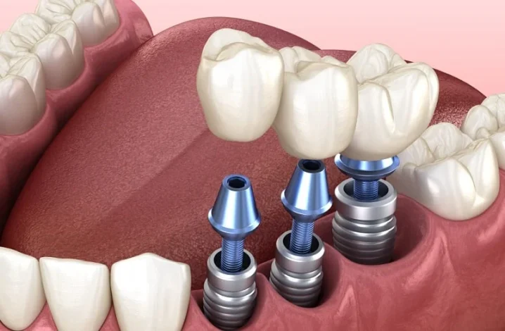 How-to-diagnose-implant-infection.