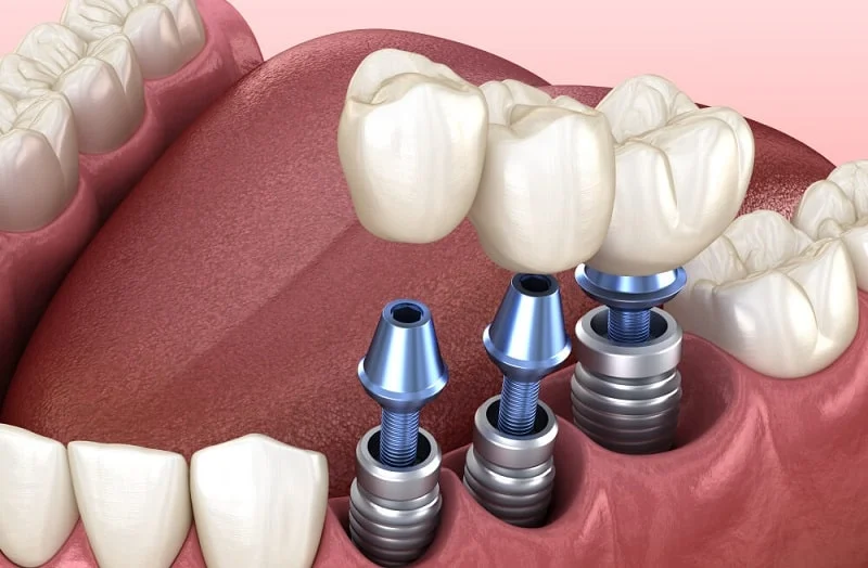 How-to-diagnose-implant-infection.