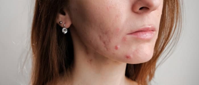 The cause of acne breakouts and ways to prevent and treat it