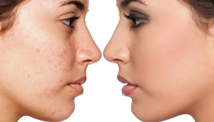 Ways to remove facial acne
