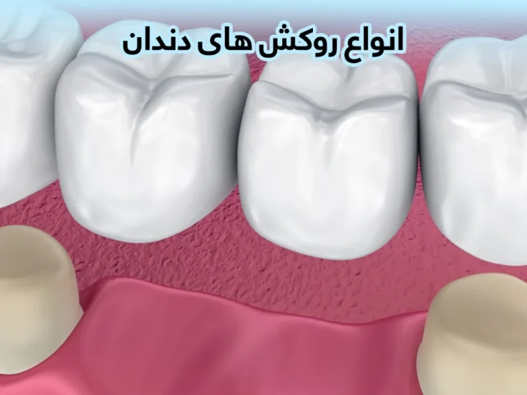 چرا دندان زیر روکش درد میگیرد؟