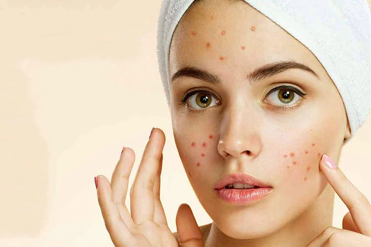 The best external acne cream