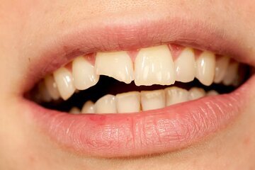 چرا دندانها زود به زود پوسیده میشوند؟